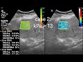 FibroScan in cirrhosis, correlation with ultrasound and color Doppler findings