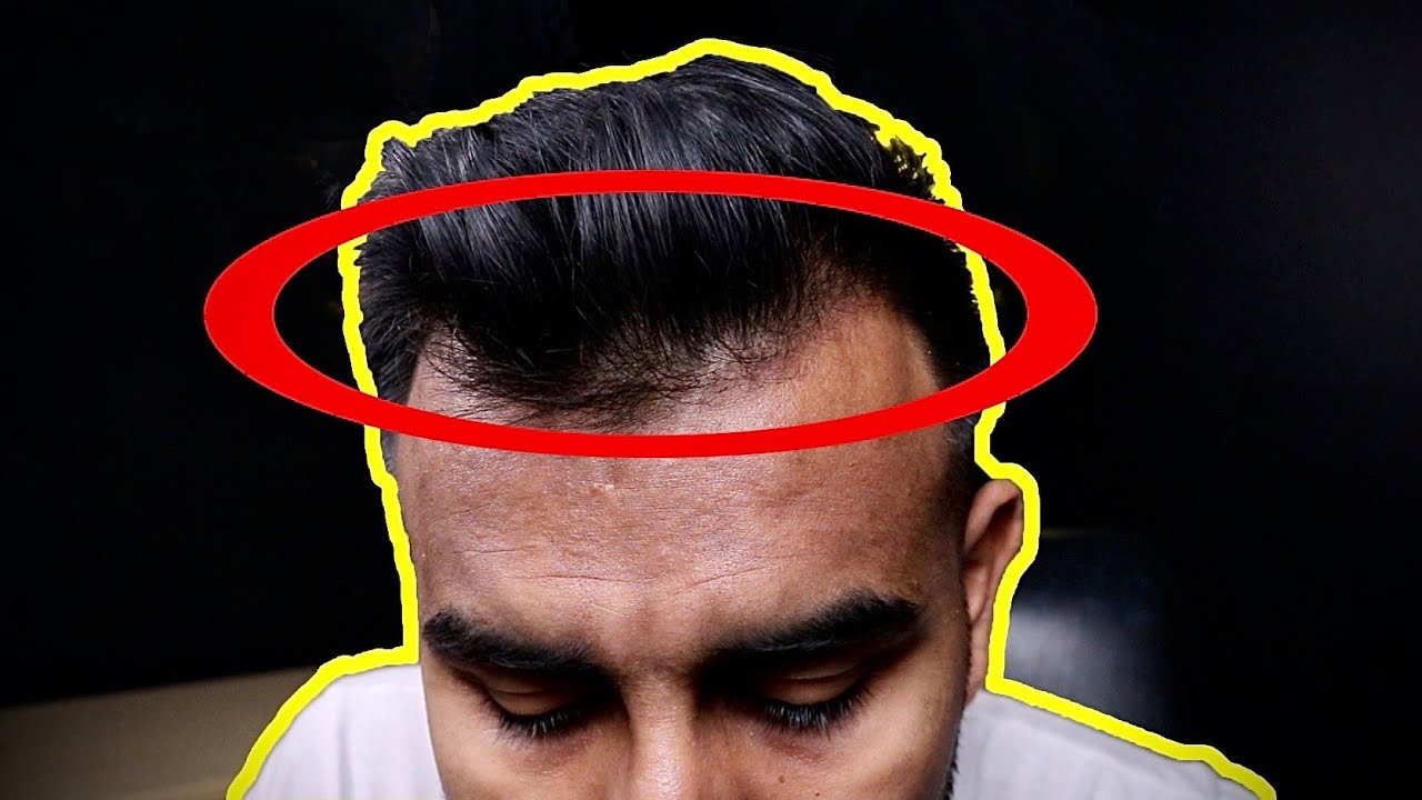 HOW TO KNOW IF YOU'RE GOING BALD AND HOW TO STOP IT FAST ...