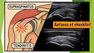 Le Supra Épineux En Échographie Astuces Et Règles Incontournables