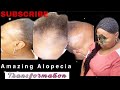 (#69) ALOPECIA BRAID STYLE “DID IT AGAIN🙌🏽”