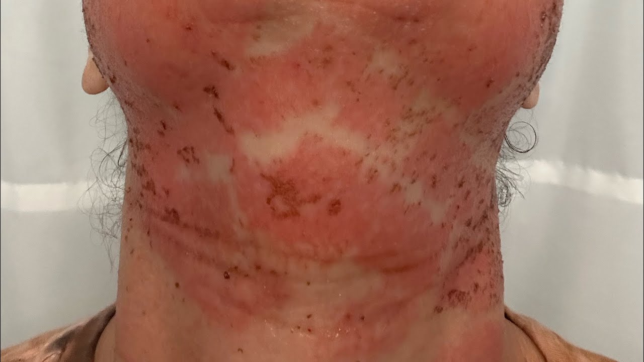 7 Day CO2 Laser Resurfacing transformation by Paul and Lauren @remedy_nh. Final results forthcoming!