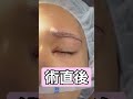 Good‼️目頭切開を組み合わせた眉下リフト、術直後。
