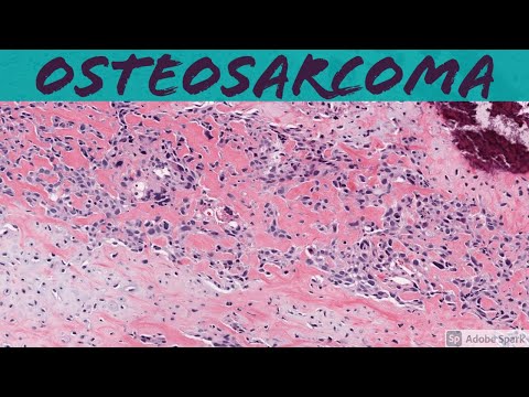 Video: Celulele Stromale Mezenchimale Mediate De Administrarea De Nanoparticule Fotoactive Inhibă Creșterea Osteosarcomului In Vitro și într-un Model Ectopic Murin In Vivo