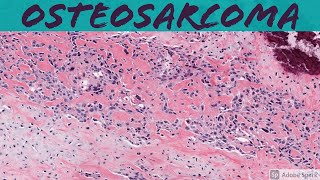 Osteosarcoma 101: Bone Pathology Basics