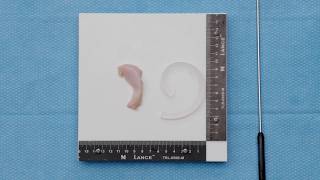 Segmental Meniscal Allograft Transplantation Using the Segmental Meniscus Procedure Pack