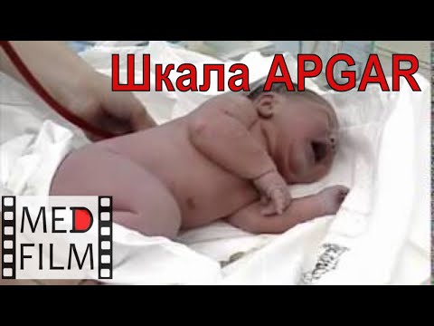 Video: Apgar Skóre: Graf, Definícia, Normálne, Dieťa A ďalšie