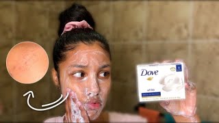 I Used Dove Soap On My Face For 1 Week | Results