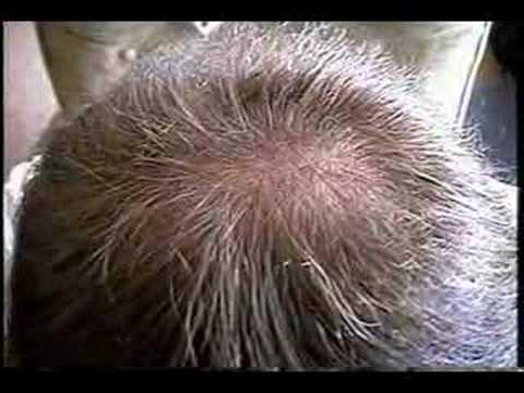 Results With Hair Regrowth using Propecia (over time)