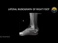 Haglund Deformity - 5 minute Learning Case by SR