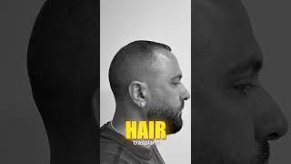 Hair transplant. Before and After of our patient | Care4Hair