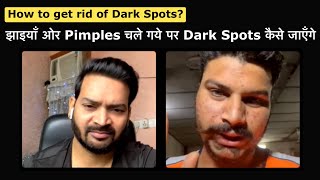 झाइयाँ ओर Pimples चले गये पर Dark Spots कैसे जाएँगे How to get rid of Dark Spots & Pimples marks 