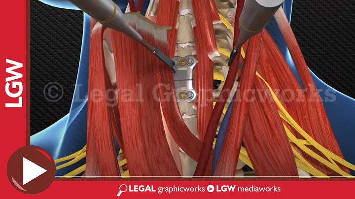 Cervical Fusion Surgery 3D animation C3-4 C5-6 C6-7 - DayDayNews
