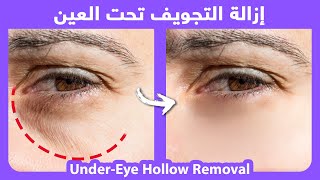 How to naturally get rid of eye hollows