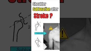 Shoulder Subluxation after Stroke.