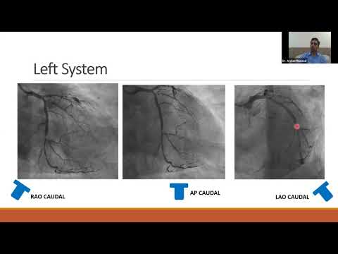 Video: Angiogram ua li cas?