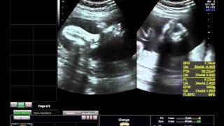 my BABY`s Ultrasound at 30 weeks 4days & baby was Breech