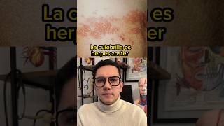 La culebrilla es herpes Zoster | Dr. William Guerrero #medicina #shorts