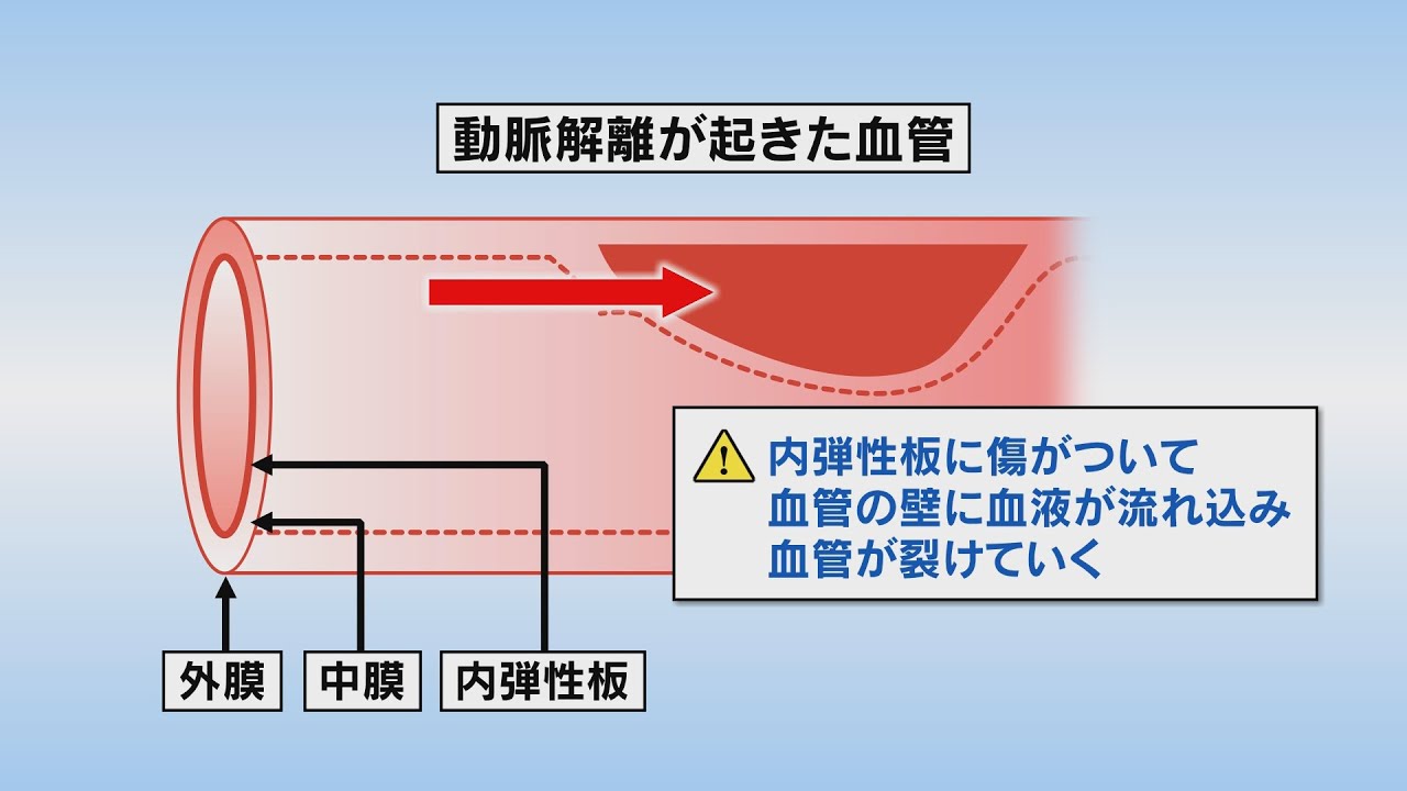 いわて元気○（マル）　【脳動脈解離】（2021/5/18放送　ニュースプラス１いわて）