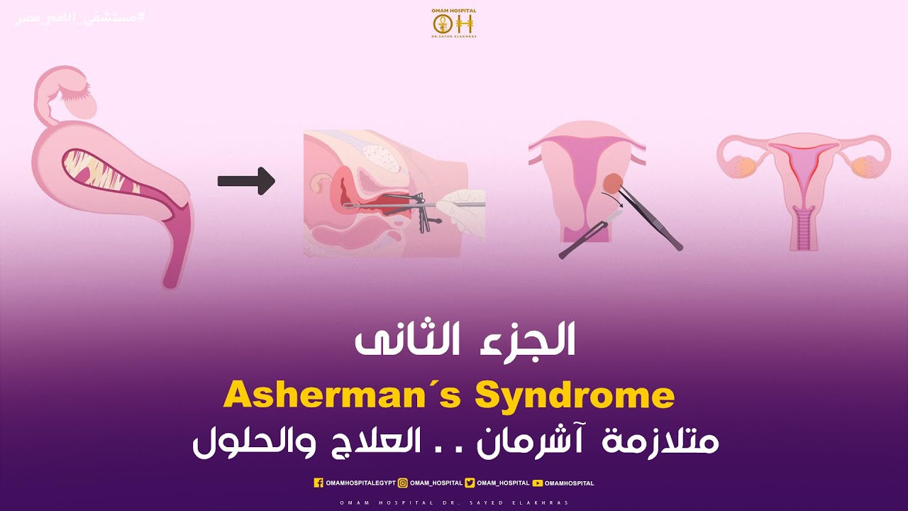 متلازمة آشرمان   التصاقات داخل تجويف الرحم      العلاج والحلول     الجزء الثانى