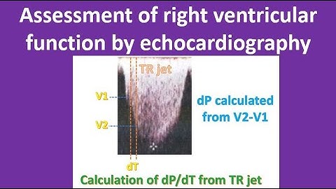 Assessment of right ventricular function by echocardiography
