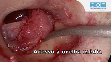 Como é feito uma cirurgia no ouvido?