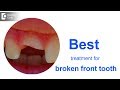 Front tooth broke off at gum line. What to do? - Dr. Ranjani Rao | Doctors' Circle