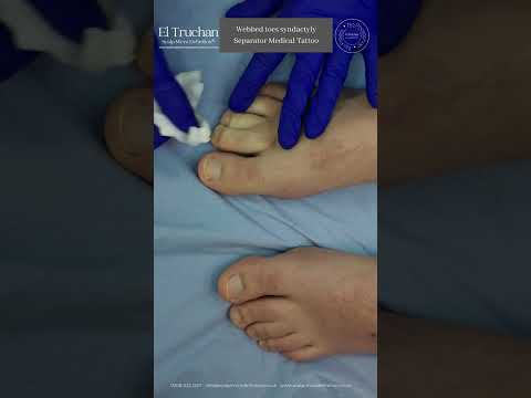Wideo: Czy błoniaste stopy są oznaką chowu wsobnego?