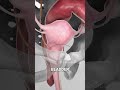 Bladder Removal (3D Animation)