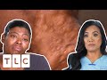 Dr. Lee Removes Multiple Cysts In Very Painful Surgery! I Dr. Pimple Popper: Pop Ups