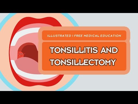 Video: Hvordan Man Behandler Kronisk Tonsillitis Hos Et Barn
