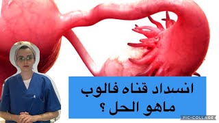 إنسداد قناه فالوب ماهو الحل - دكتوره سلوى الفرا