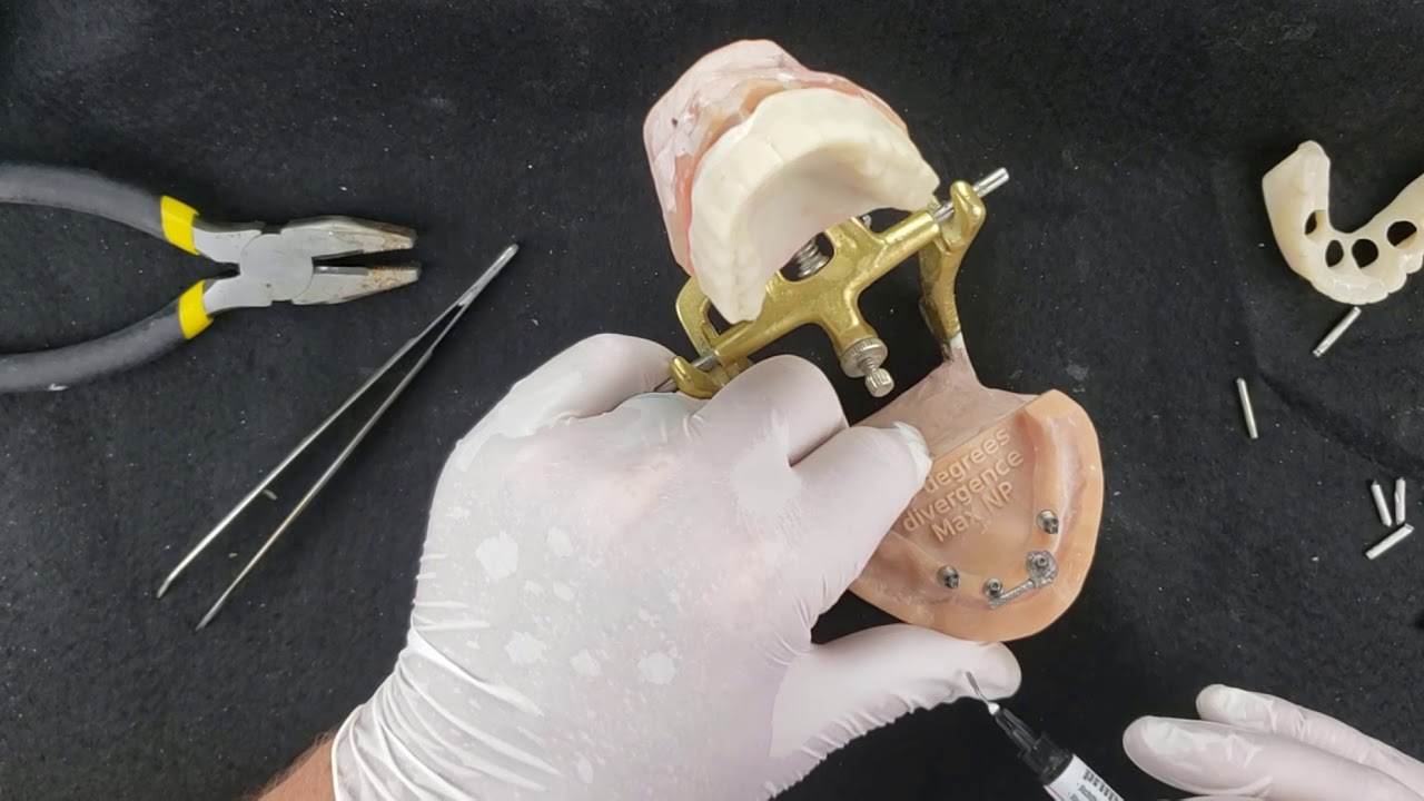 Taking Verified Full Arch Implant Master Impression and VDO Records in 1 appointment