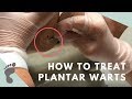 How To Treat Plantar Warts