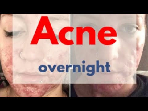 Acne, pimples and skin problems/ acne problem solve with in one night ...