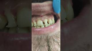 حشو تجميلي للاسنان الامامية||restoration composite of upper anterior teeth