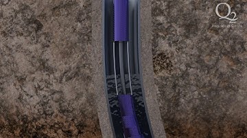 Q2ALS CPT  - Video 2020