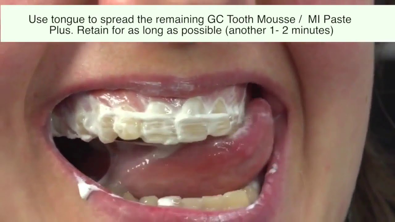 2 Methods to Use GC Tooth Mousse I Tooth Mousse Plus I MI Paste