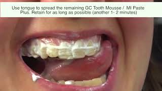 2 Methods to Use GC Tooth Mousse I Tooth Mousse Plus I MI Paste screenshot 4