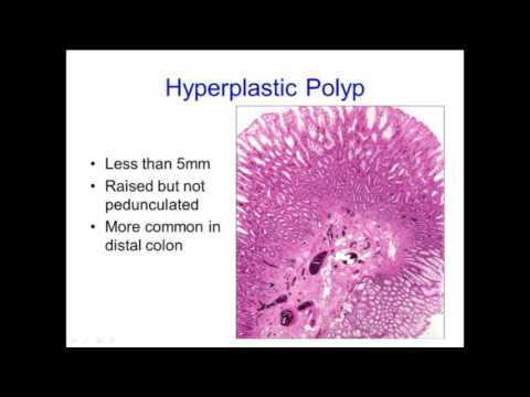 Hyperplastic Polyps: Not Always What They Seem