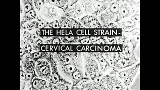 The HeLa Cell Strain: Cervical Carcinoma (Assn of American Medical Colleges, 1956)