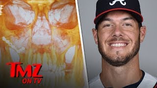 MLB's Josh Ravin Shows X-Ray After Line Drive to Face | TMZ TV