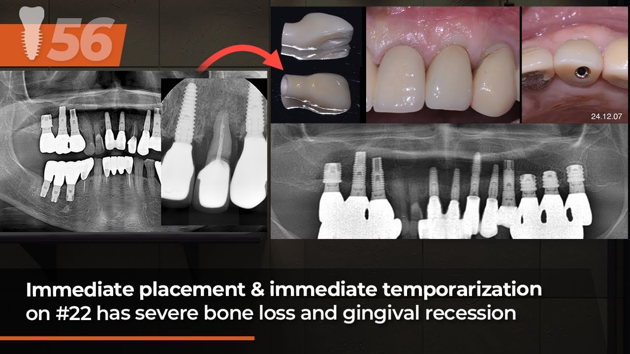 Immediate placement & immediate temporization on #22 has severe