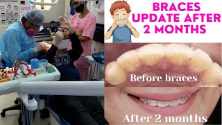 2 months Braces Update | Adult Braces journey | Braces process vlog #braceswithdolly