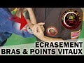 Ecrasement points vitaux  stage scj