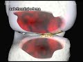 Torn Meniscus (cartilage) and Arthritis of the Knee Animation by Cal Shipley, M.D.