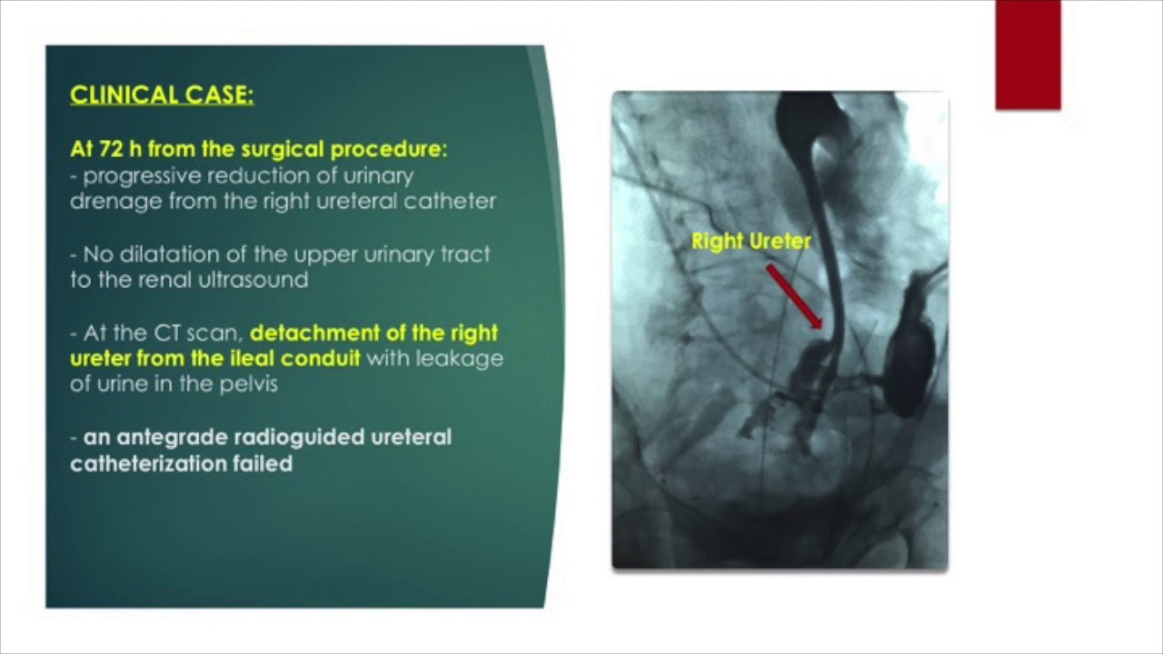 Condotto Ileale Sec. Bricker (per Neoplasia Vescicale) - YouTube