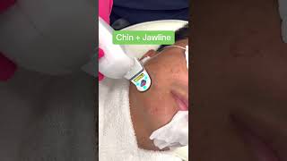 TREAT ACNE WITH AVICLEAR LASER