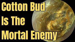 Cotton Bud Is The Mortal Enemy