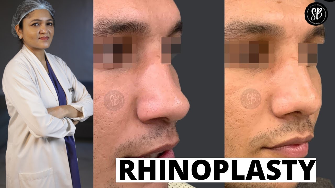 Rhinoplasty Surgery for Wide/Deviated Nose Nose Job in