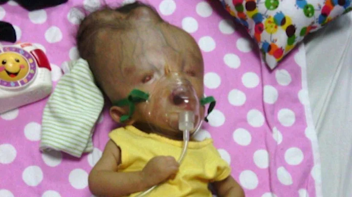 Toddler with Birth Defects 'Incompatible with Life' Defies Odds in Venezuela - DayDayNews